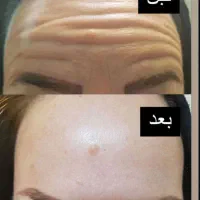 فیلر اقتصادی بوتاکس پیرسینگ|خدمات آرایشگری و زیبایی|ایرانشهر, |دیوار