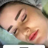 بلفاروپلاستی ،سانترال لب،بوکال فت،غبغب