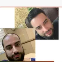 اقساطی کاشت مو تضمینی/کاشت ابرو کاشت|خدمات آرایشگری و زیبایی|تهران, چیذر|دیوار