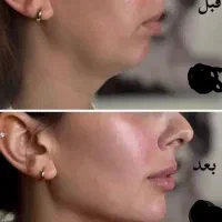 تزریق ژل فیلر بوتاکس مزو فیلر بادی قیمت استثنایی