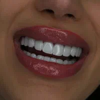 اف ویژه کامپوزیت ونیر کامپوزیت