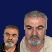 کاشت مو ،ابرو و ریش