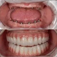 دندانپزشکی،اوردنچر دو فک ۱۸۵ تومن در تبریز