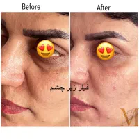 تزریق و آموزش بوتاکس و ژل و پرسینگ و مزو و غیره|خدمات آرایشگری و زیبایی|شیراز, نصر|دیوار