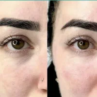 تخفیف ویژه تزریق فیلر|خدمات آرایشگری و زیبایی|اندیشه, اندیشه فاز ۱|دیوار