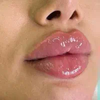 آموزش تزریق ژل لب.ژل گونه بوتاکس انواع مزوتراپی|خدمات آموزشی|آبادان, |دیوار