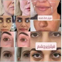 ژل لب/گونه/بوتاکس/فیلربینی/مزوپی ار پی|خدمات آرایشگری و زیبایی|مشهد, سجاد شهر|دیوار