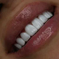 جشنواره کامپوزیت دندان اقساطی