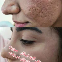 بازسازی درمان جای جوش آکنه باروش تخصصی NBR در کشور|خدمات آرایشگری و زیبایی|رشت, فلسطین|دیوار