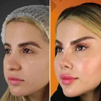عمل جراحی بینی و لیفتها