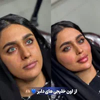 ژل و بوتاکس