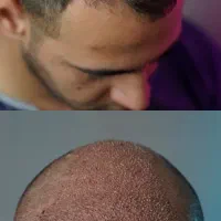 کاشت تخصصی مو به روش FIT|خدمات آرایشگری و زیبایی|رشت, گلسار|دیوار