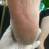 -رفع ترک و پینه پا با تکنیک تخصصی