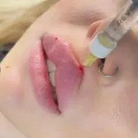 مطب زیبایی پوست مو ژل بوتاکس prp مزو آنزیم  نخ