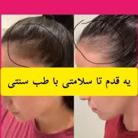 درمان ریزش مو ومشکلات پو،ست ومو
