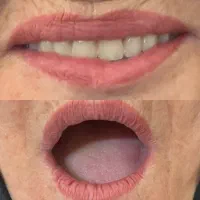 دندان مصنوعی بدون لقی با روش Semcd/Bps