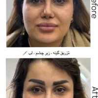 جشنواره ژل بوتاکس نخ فیلر