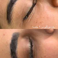 درمان پوست باتخفیف بلک فرایدی/پوست کره‌ای/کاموفلاژ|خدمات آرایشگری و زیبایی|پاکدشت, پاکدشت (مامازند)|دیوار