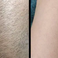 جشنواره لیزر با تخفیفات ویژه