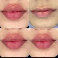 بمب تخفیفات امروز ژل و بوتاکس 50%تخفیف برای 5نفر