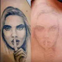 پاک کردن تتو و کک و مک و رفع تیرگی در شهرری