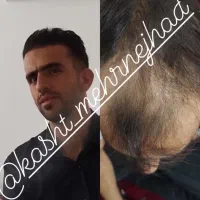 کاشت مو و ابرو اقساطی