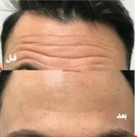 هدیه روز مادر آف ژل وبوتاکس|خدمات آرایشگری و زیبایی|ایذه, |دیوار