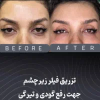 بوتاکس زیر بغل