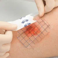 پانسمان نوین زخم بستر / دیابتی / سوختگی / سرطانی