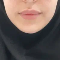 جشنواره بوتاکس/فیلر/مزوتراپی/ prp/انواع جوانسازها