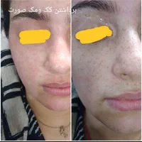 تخفیف تخفیف تخفیف هایفو تراپی وجوانسازی|خدمات آرایشگری و زیبایی|مشهد, امیر|دیوار