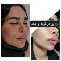 تزریق ژل لب،تزریق ژل گونه ،تزریق ژل چانه، بوتاکس|خدمات آرایشگری و زیبایی|ساری, |دیوار