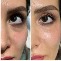 تزریق ژل و بوتاکس جشنواره عید|خدمات آرایشگری و زیبایی|تهران, عبدل‌آباد|دیوار
