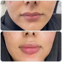 پی آرپی ۸۵۰بوتاکس ۸۵۰فیلر ۸۵۰|خدمات زیبایی و سلامت|کرمانشاه, |دیوار