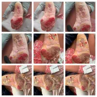 متخصص و درمانگر زخم های مزمن و حاد