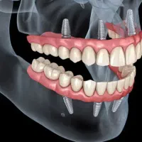 کاشت ایمپلنت