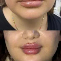 تزریق ژل و بوتاکس و مزو