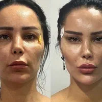 جشنوار بلفاروپلاستی-غبغب-بوکال فت-سانترال لب