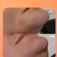 لیزرموهای زائد هنوزباقیمت قبل توعکسهارضایتهاروببین|خدمات آرایشگری و زیبایی|شیراز, ستارخان|دیوار