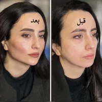 هایفو ۲۴ بعدی صورت و بدن به مدت محدود ۸۰۰|خدمات آرایشگری و زیبایی|مشهد, کوثر|دیوار