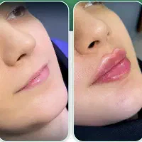ژل فیلر بوتاکس جوانساز مزوژل آنزیم صورت و بادی|خدمات زیبایی و سلامت|تهران, شهرک شریعتی|دیوار