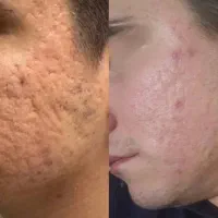 لیزر Co2 فرکشنال فوتونا درمان قطعی مشکلات پوستی
