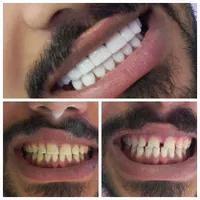 کامپوزیت دندان ( طرح لبخند )|خدمات آرایشگری و زیبایی|یاسوج, |دیوار