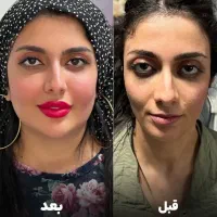 فیلربادی مزوژل فیلر صورت لیفت شقیقه بوتاکس فول فیس|خدمات زیبایی و سلامت|اصفهان, سعادتآباد|دیوار