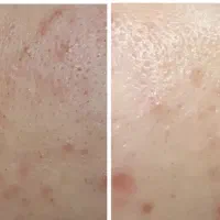 فشیال تخصصی vip پوست به مدت 3 روز فقط 170 تومن|خدمات آرایشگری و زیبایی|مشهد, آزادشهر|دیوار