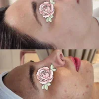 پاکسازی پوست و فیشال تخصصی با دستگاه