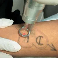 پاک کردن تتو ،خالکوبی و کک و‌مک با لیزر