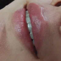 ژل و بوتاکس