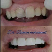 ایمپلنت/کامپوزیت/دندانپزشکی/اقساط|خدمات آرایشگری و زیبایی|شیرگاه, |دیوار