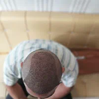 کاشت موی تخصصی و تضمینی|خدمات آرایشگری و زیبایی|تبریز, |دیوار
